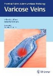 Varicose Veins - Practical Guides in Interventional Radiology
